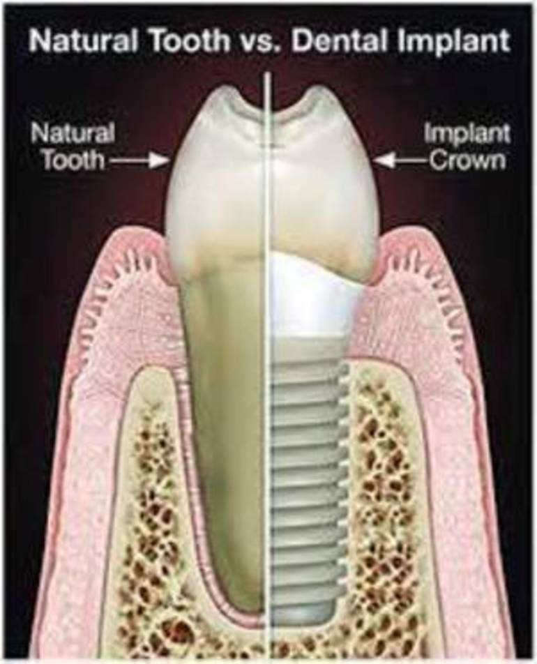 Red Bank “DocSmiles” Explains the Differences in Implants TAPinto