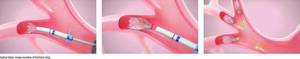 Carousel image c9410fd1642661ddda7d best crop 0dfd71ca9b5c0cd4ff5f lung valves final med