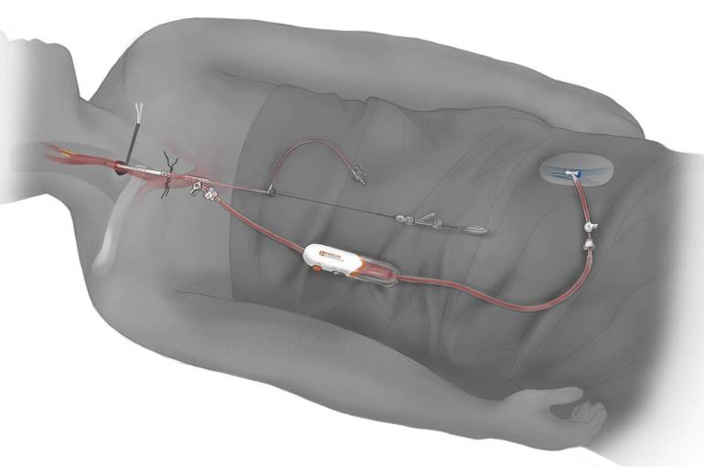 Overlook First in NJ to Offer Carotid Artery Stroke Prevention