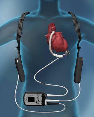 Carousel image 51f688f4d2bc14cdfdc7 best crop 16f6d174430a63e0788e the abbott heartmate 3  lvad device. photo courtesy of abbott.